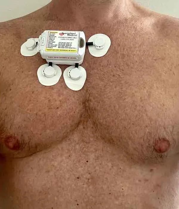 Holter monitor device attached to patient's chest with electrode leads